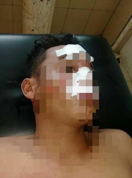 Ditimpa Pupuk, Buruh Pelabuhan Ini Luka Berat